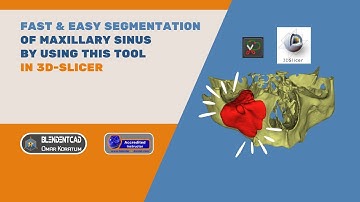Fast & Easy 3D Slicer Segmentation of Maxillary Sinus by using this tool
