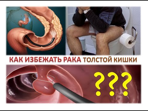 Видео: Как избежать рака толстой кишки? Самая лучшая профилактика.  Простыми словами о раке кишечника.