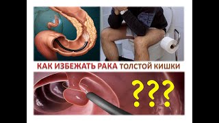 Как избежать рака толстой кишки? Самая лучшая профилактика.  Простыми словами о раке кишечника.