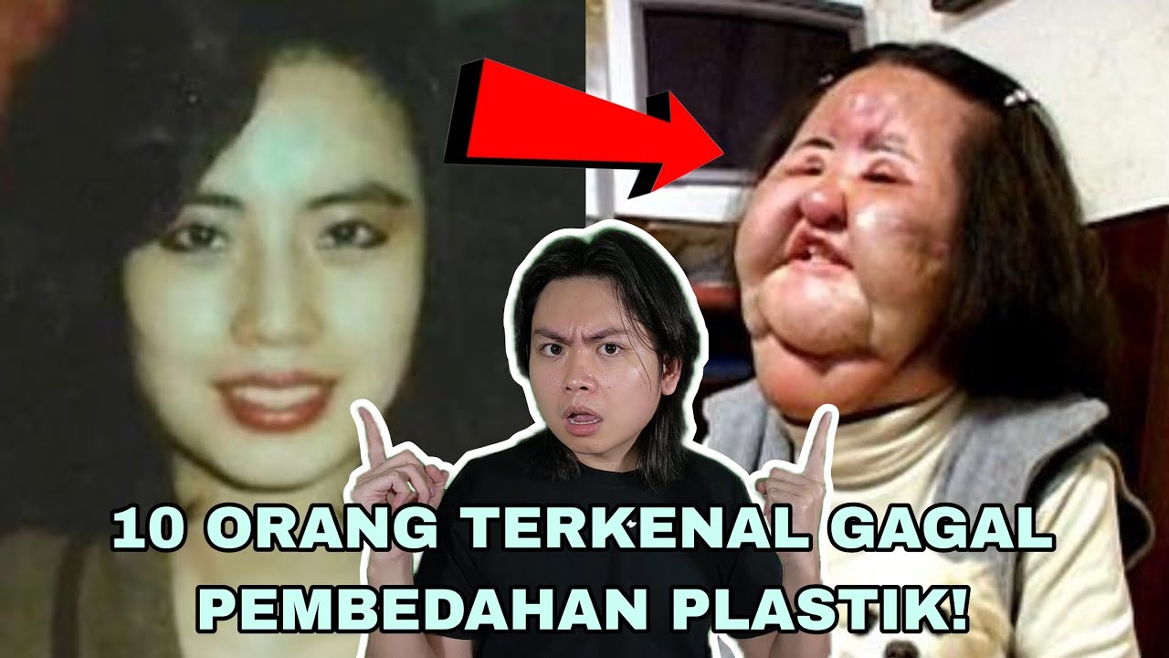 10 Orang Terkenal Gagal Pembedahan Plastik