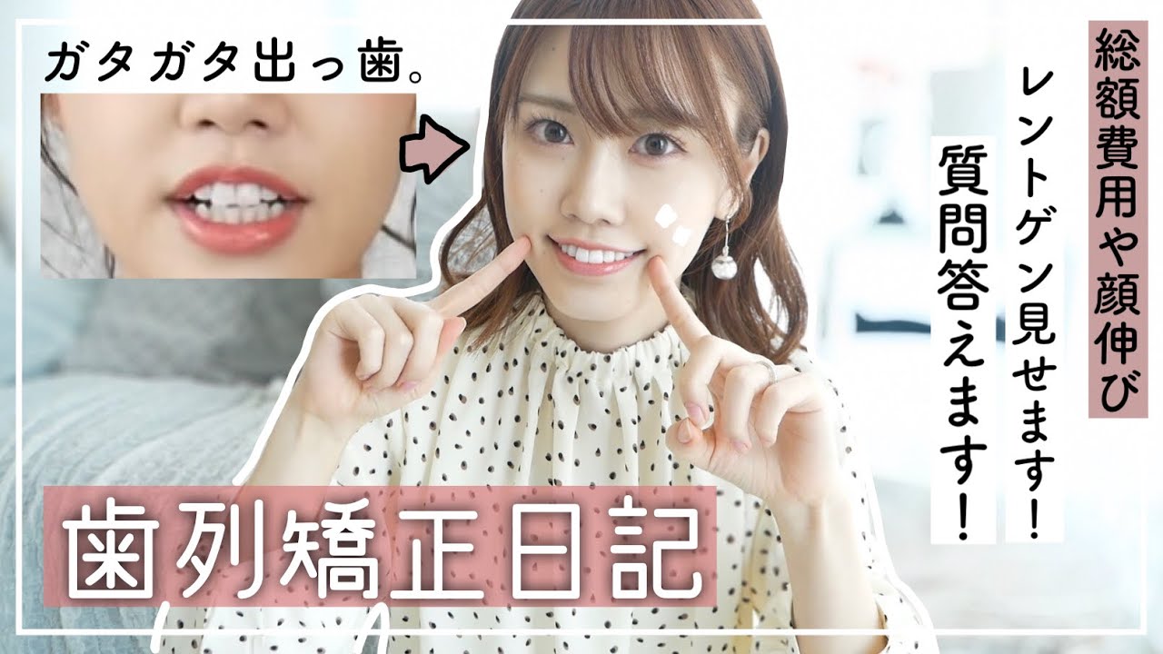 歯列矯正】インビザライン1年2ヶ月🦷費用/顔伸びた!?/レントゲン写真