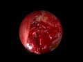 AC Polyp , Antrocoanal polyp , fess - Dr Hitesh Patel