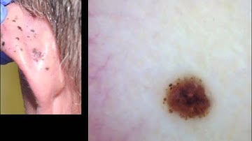 Homogenous blue lesions and many faces of metastatic melanoma by Dr. A. Marghoob