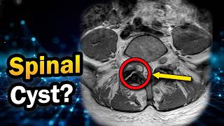 Sciatica but Normal Discs? The Hidden Spinal Cyst Explained