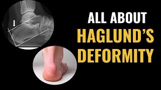 How Do I Treat A Haglund's Deformity?