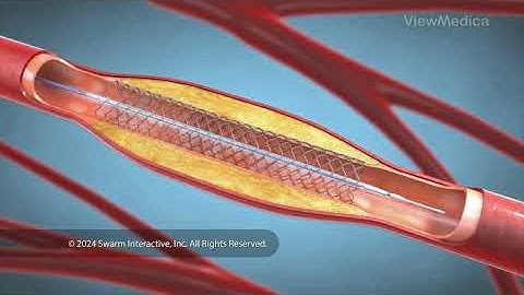 What is a stent? (3D animation)