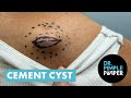 Its like a cement truck  dr pimple popper removes the cement cyst