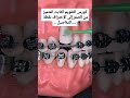 كورس التقويم الثابت من الصفر الى الاحتراف نقطة للتفاصيل طبيبة اسنان تقويم دورات تدريبية ترند