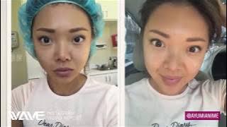 WAVE patient Ayumi Kim Gets Voluma!