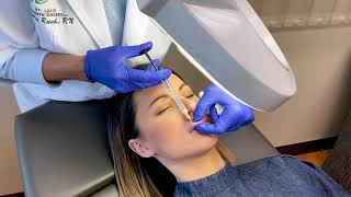 Lip Filler With Restylane Kysse St Louis Cosmetic Surgery