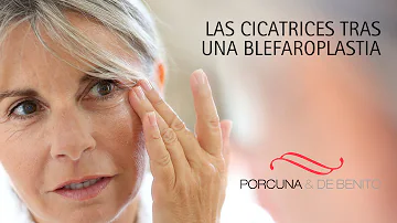 ¿Cuánto tardan en desaparecer las cicatrices de la blefaroplastia?