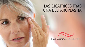 ¿Se ven las cicatrices de la blefaroplastia?