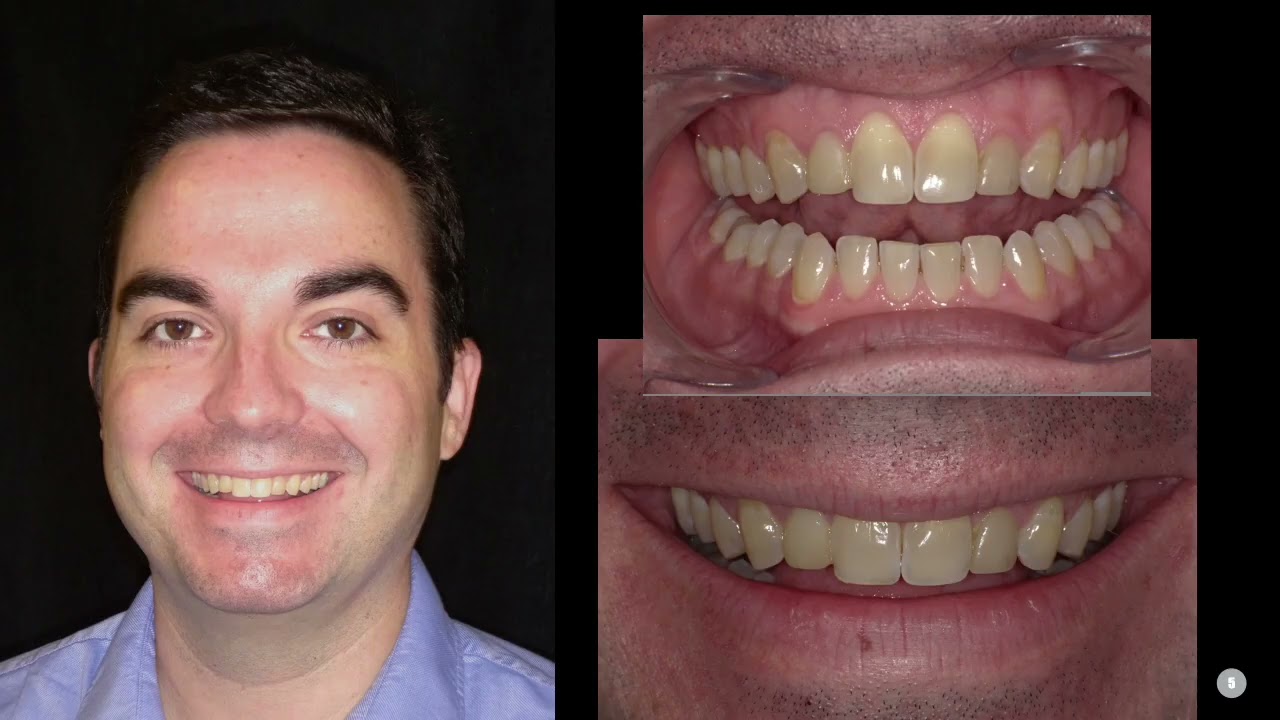 Troubleshooting Teeth Whitening | Solving Common Problems & Improving Outcomes