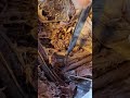 دیسکسیون سطحی گردنNeck dissection
