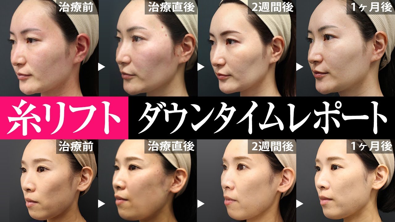 糸リフトの効果と3週間のダウンタイム【30代女性2人の症例】 - YouTube