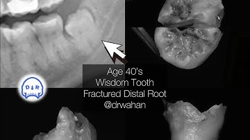 Root Fracture During Wisdom Tooth Extraction @drwahan