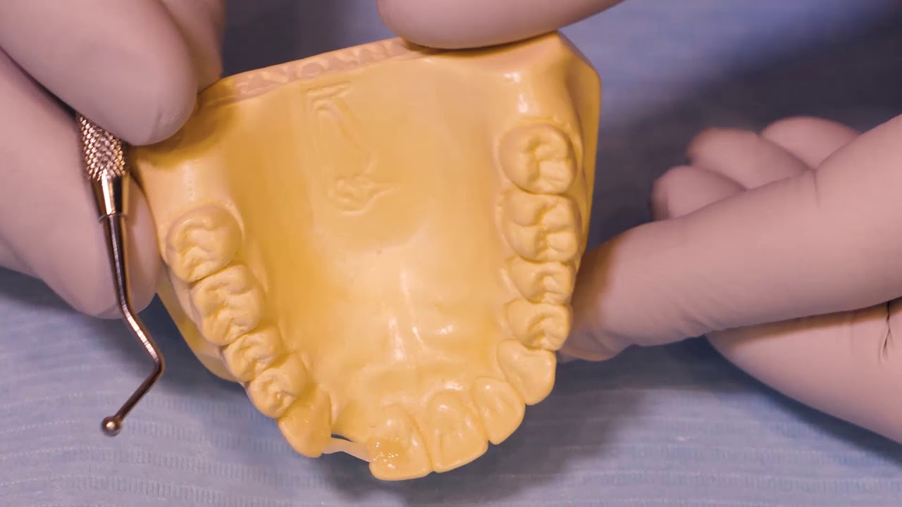 Lekcja 5: Modelowanie brakującego zęba metodą nieinwazyjną za pomocą WŁÓKNA KOMPOZYTOWEGO