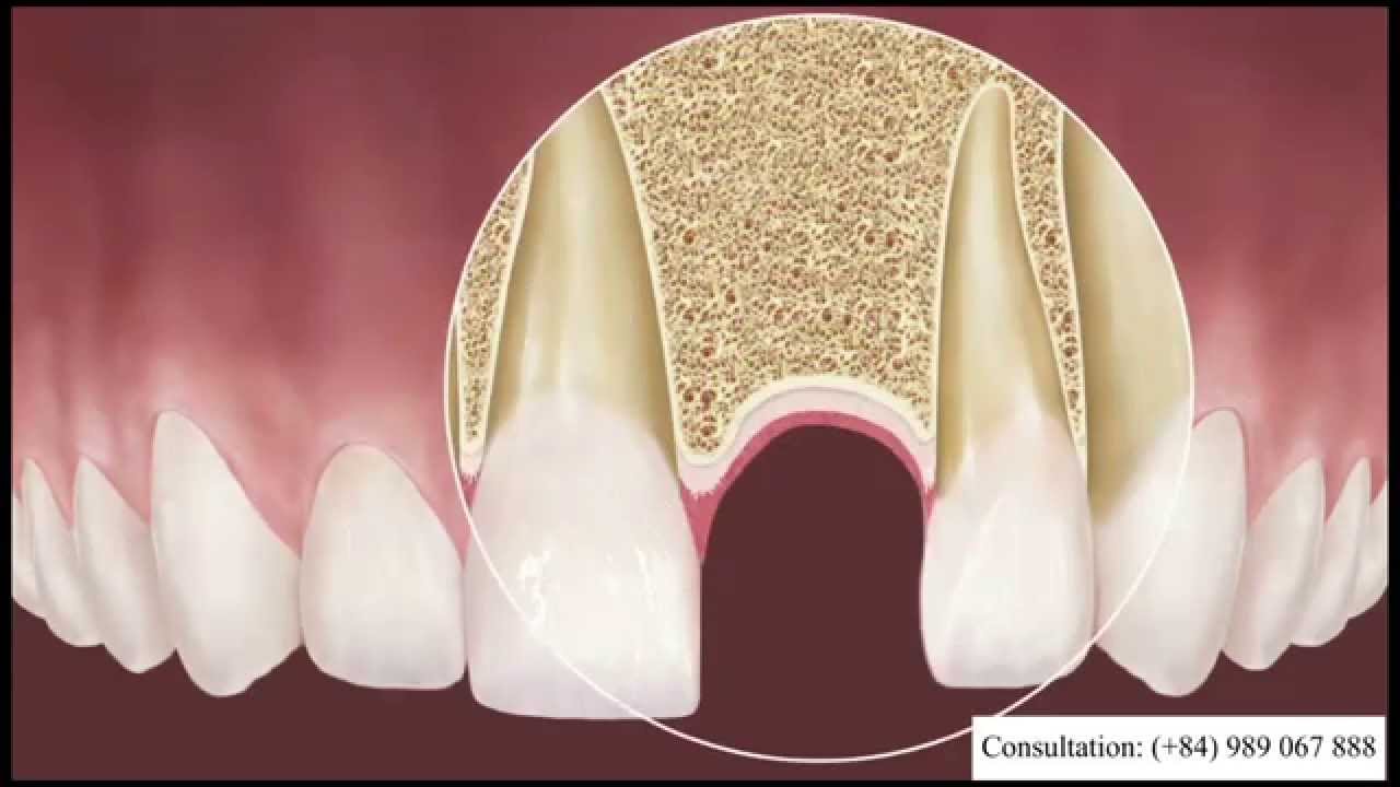 Dental Implant in Vietnam Serenity International Dental Clinic Hanoi