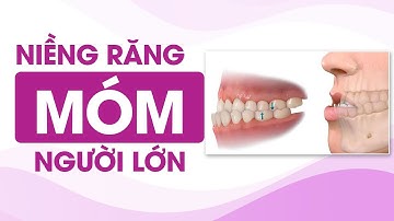 Niềng răng móm là gì? Niềng răng móm cho người trưởng thành