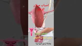 اسباب ميلان الرحم#امراض_نسا #ميلانالرحم #الرحمالمقلوب