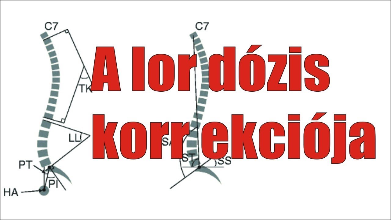 lordosis lumbalis jelentése magyarul