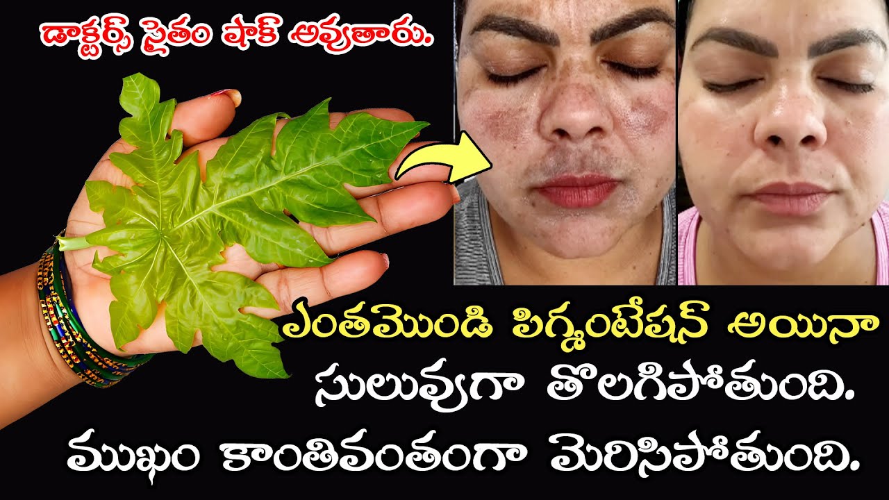 కేవలం 7 రోజులు చాలు 🌟పక్కా రిజల్ట్ 👍మొండి పెగ్మెంటేషన్ పోవడం సాధ్యమే! 🤯డాక్టర్లకే షాక్ ఇచ్చిన చిట్కా