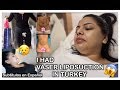 My Vaser Liposuction Journey | Maya Medical | Andrea Roman