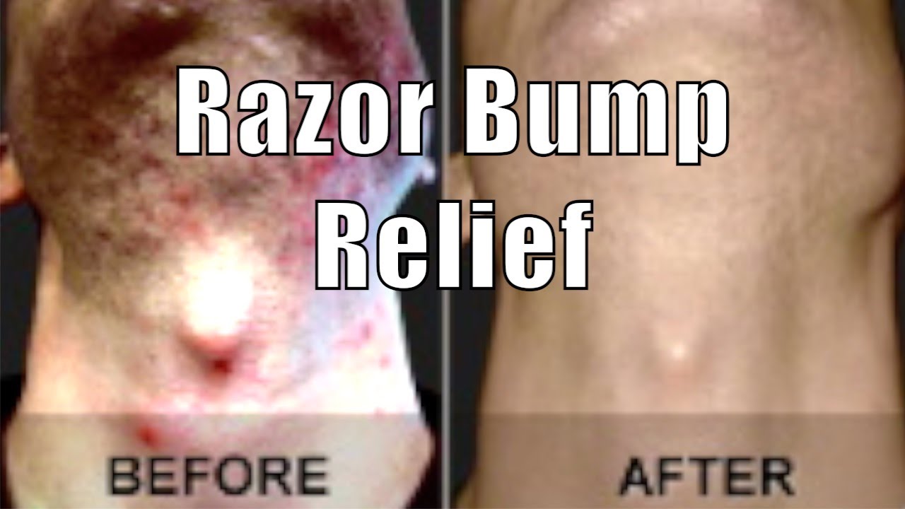 ASPIRIN RAZOR BUMP RELIEF | Cheap Tip #8 - YouTube