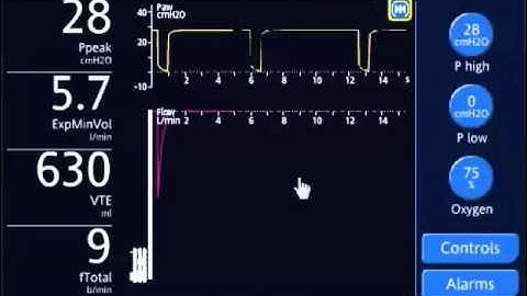 APRV: Titrating T-Low to improve oxygenation