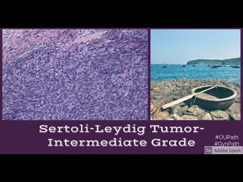 Sertoli Leydig Tumor, Moderately Differentiated