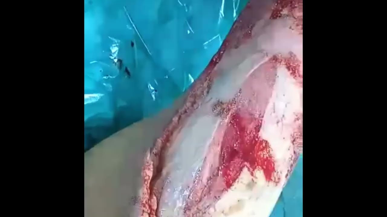 NPWT ( Negative pressure Wound therapy)