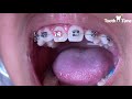 Impacted Canine Braces Treatment - Video 1 - Tooth Time Family Dentistry New Braunfels