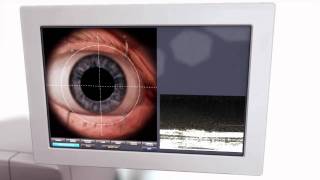 LenSx Laser Cataract Surgery (Blade Free)