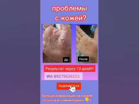 Облазиет кожа на руках - YouTube