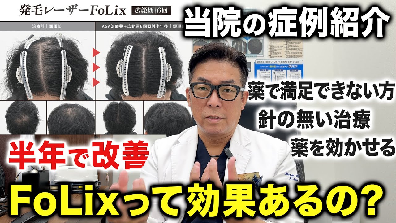【解説】発毛レーザーFoLixの効果について私の見解を話します【AGA薬を効かせる】