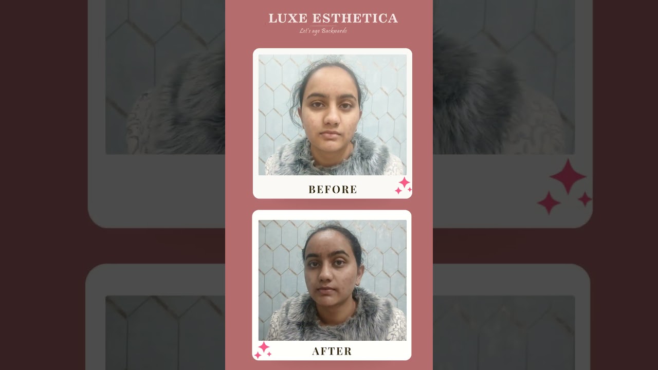Watch the Glow! Carbon Facial Transformation | Luxe Esthetica