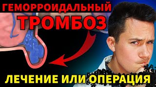 Геморроидальный тромбоз I Лечение или Операция | Геморрой