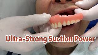 UNBELIEVABLE SUCTION! 😱 No More Loose Dentures (Watch Till The End)#SuctionDentures#SEMCD
