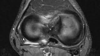 Fibular collateral ligament sprain and meniscus fascicle tear