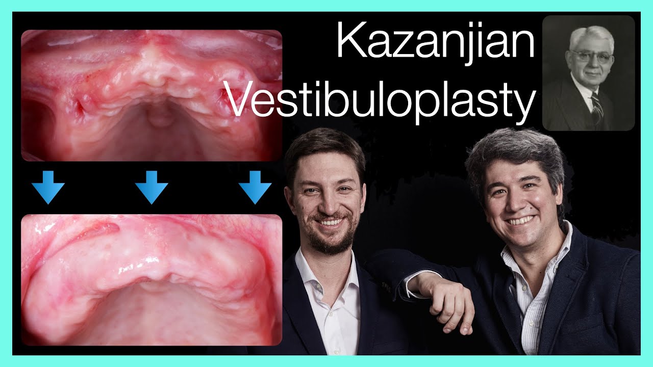 🇺🇸Kazanjian Vestibuloplasty 🔥 in Oral Implantology Soft Tissue