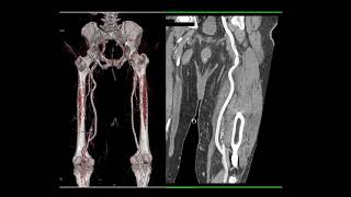 CT of Abdominal Aorta: Aneurysms, Dissections and Repair Part 1 screenshot 1