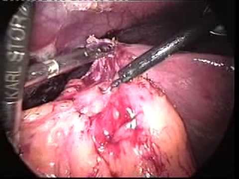 Laparoscopic Videos (edited-7)- Lap Chole In Cholecystoenteric Fistula-2