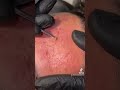 Blackheads removal