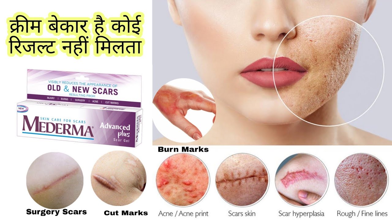 Mederma Cream अच्छी नहीं है😡Skin काली हो रही है कोई फायदा नहीं मिलता