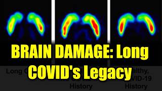 Full Unraveling Long COVID's Impact: Brain Damage and Dopamine News