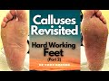 Calluses Revisited: Follow-up Treatment For The Man With Hard Working Feet (Part 2)