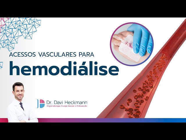 Fístulas, cateter e próteses para hemodiálise | Dr. Davi Heckmann