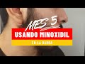 USANDO MINOXIDIL| MES 5