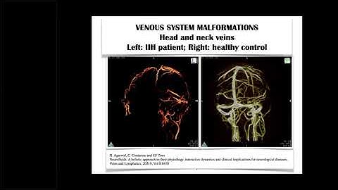 CSF Dynamics Coupled to Global Circulation in Holistic Mathematical Models - Eleuterio Toro, PhD
