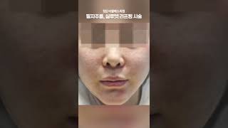 점점 깊어지는 팔자주름 고민! 팔자주름 리프팅엔 실루엣리프팅